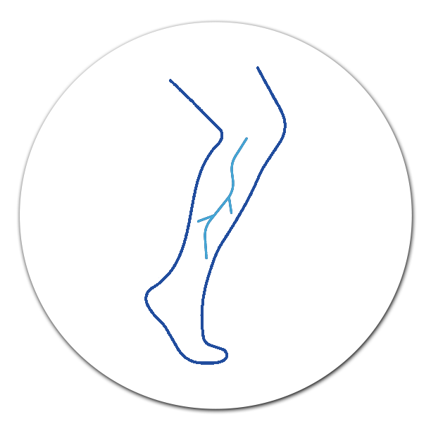 Varicose Veins