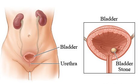 Bladder Stone