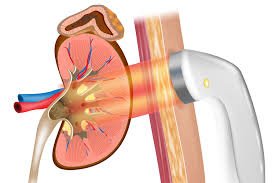 ESWL treatment for kidney stones